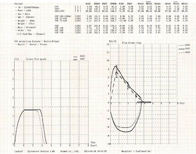 spm-300 Pre-Post Bronchodilator Comparison Report